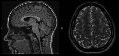 Case report: Lingering post-concussive symptoms in a pediatric patient with presumed Ehlers-Danlos syndrome